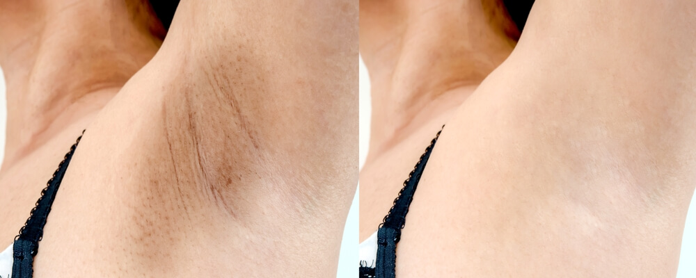 underarms