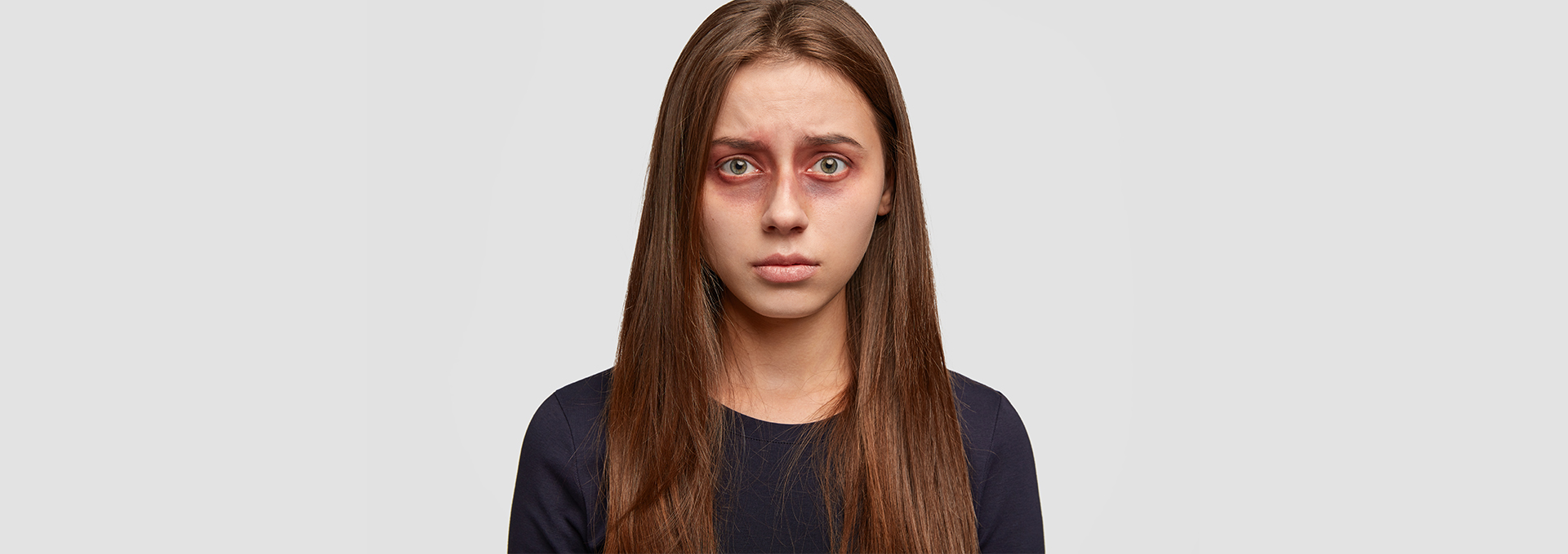 dark circles