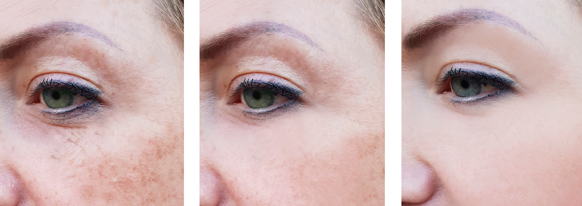 pigmentation