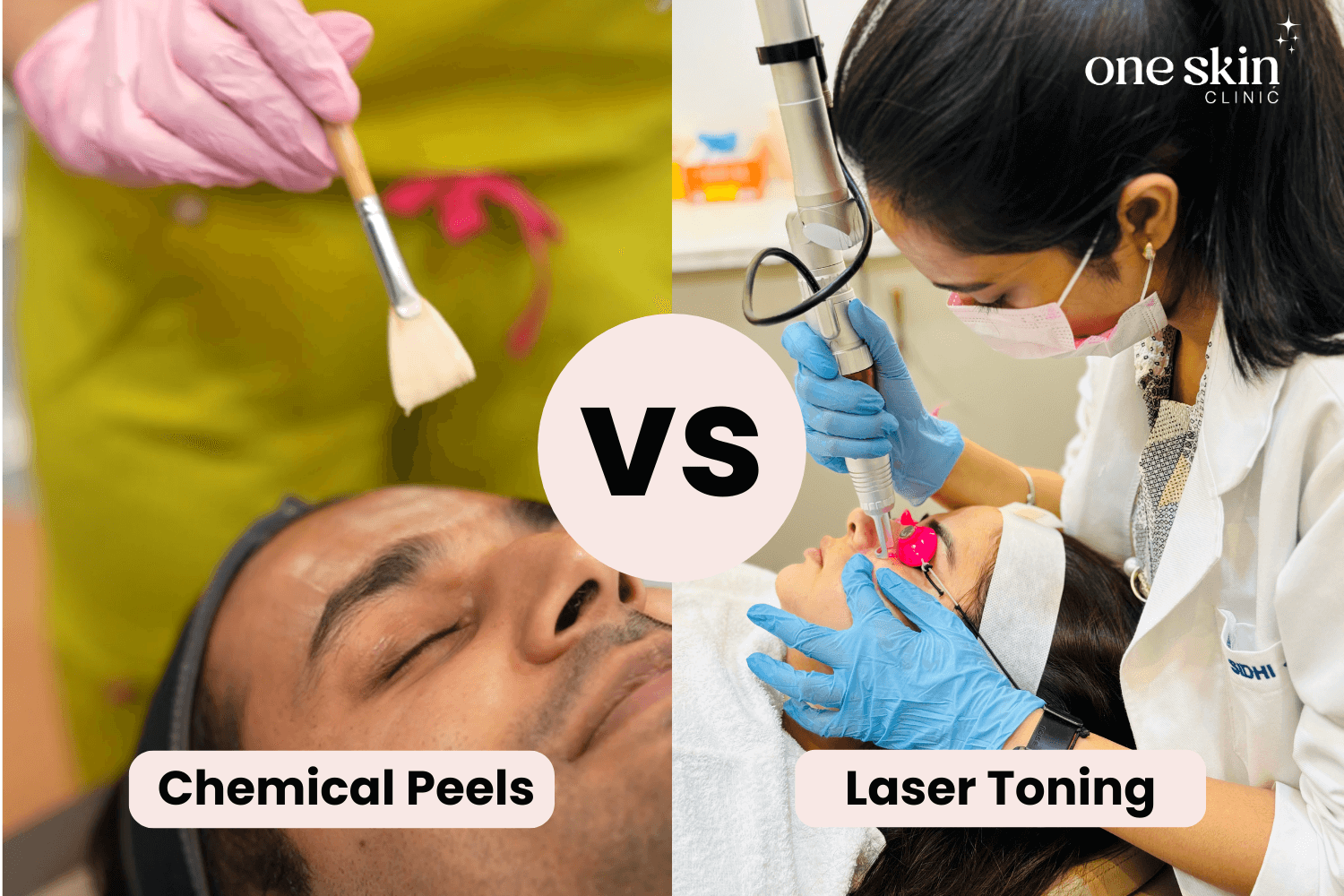 Chemical Peels vs. Laser Toning