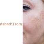 Laser Treatment for Pigmentation in Faridabad: From Dull to Radiant