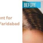 Hair Loss Treatment for Men & Women in Faridabad
