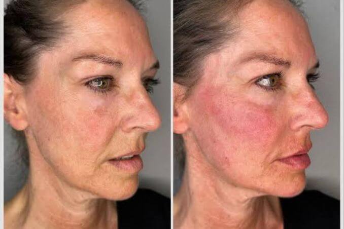 Skin Booster Treatment
