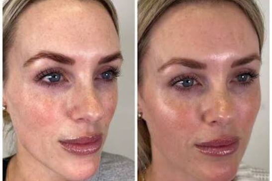 Skin Booster